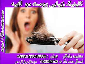 درمان ریزش موی ارثی در خانم ها چیست  ؟