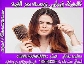 درمان ریزش مو  شدید در خانم ها 1