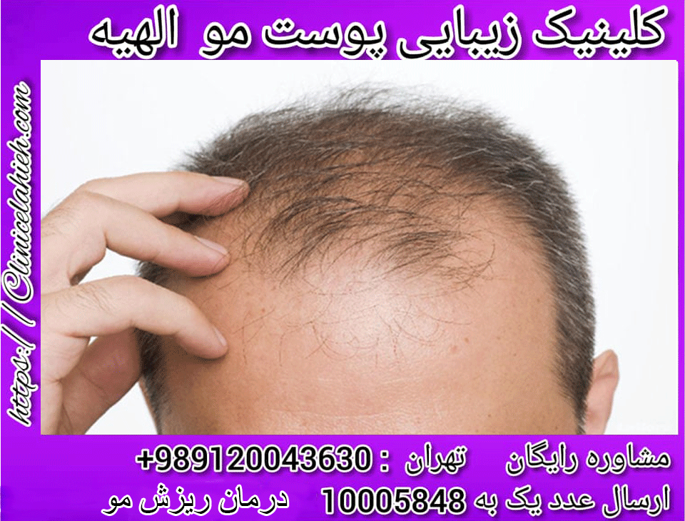 درمان ریزش مو  1
