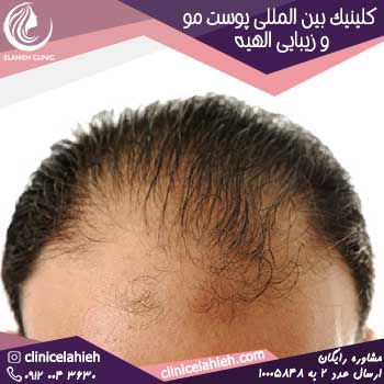 درمان ریزش مو  شدید در طب سنتی چیست؟
