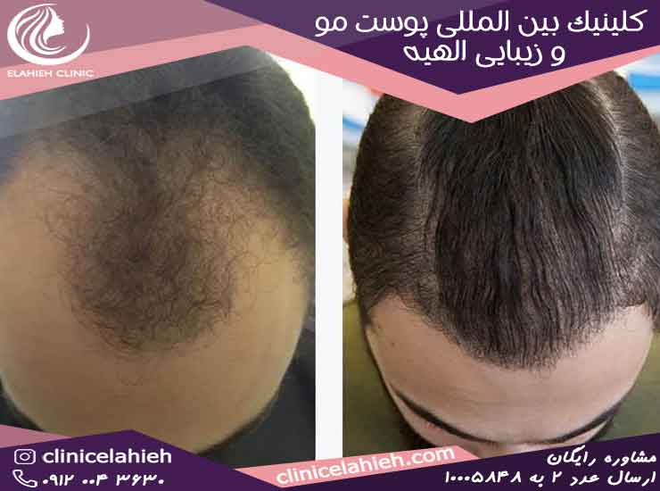 کاشت مو بدون بانک مو (روش جدید سلول های بنیادی) - کلینیک بین المللی ...