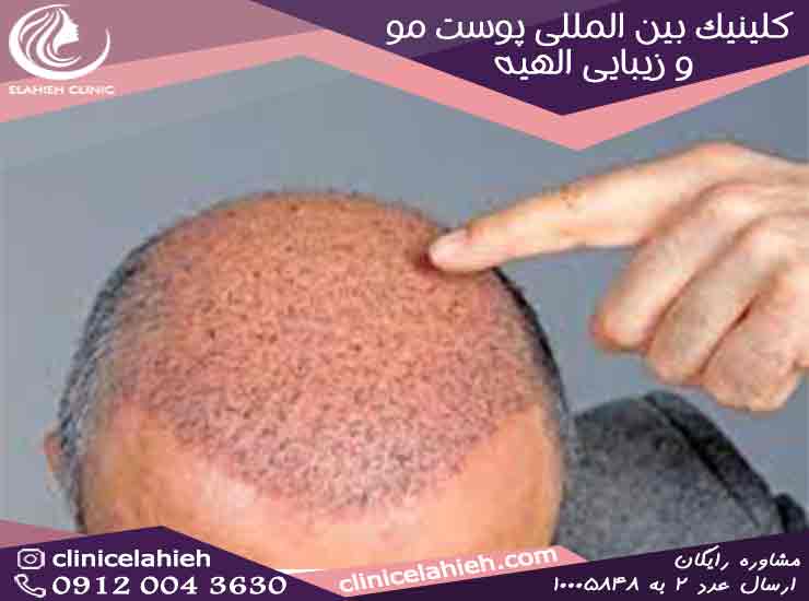 درمان قرمزی پوست سر بعد از کاشت مو