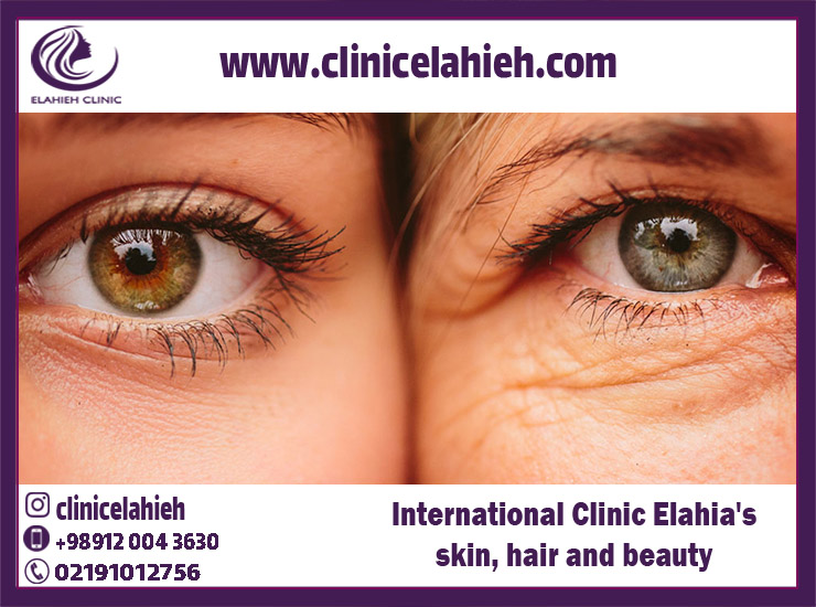 Elahieh Beauty International Hair and Skin Clinic - Eyelid Surgeon